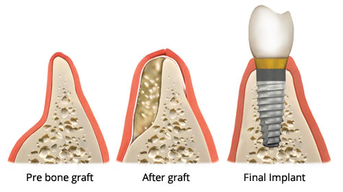 Bone Graft Illustration