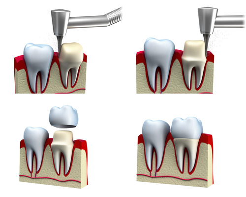 Dental Crown Installation