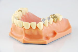 Dental Filing Model