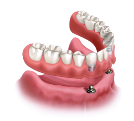 Implant Supported Dentures