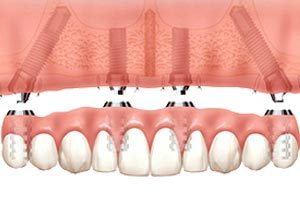 Full Teeth Replacement