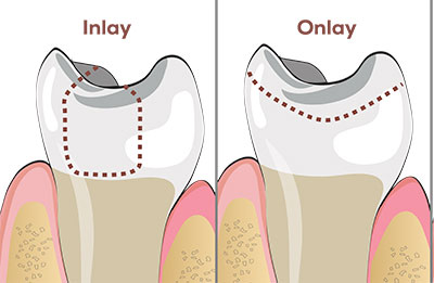 Inlay Onlay tooth illustration