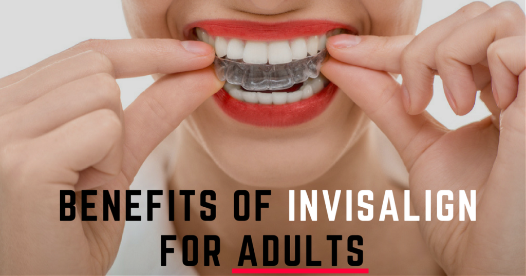 Benefits of Invisalign for Adults