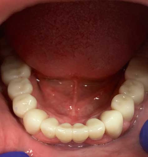 Full Mouth Rehab Lower After