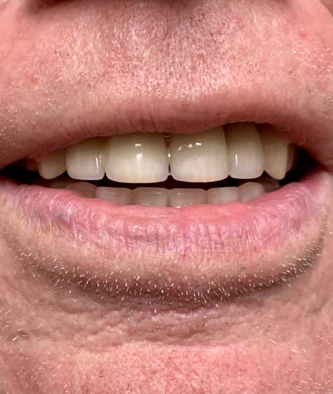 patient-mouth-rehab-implants-1