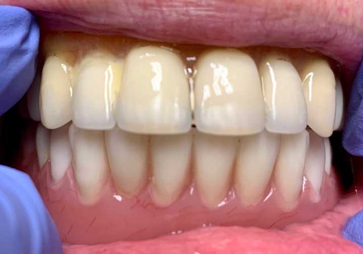 Implants with Snap on Denture