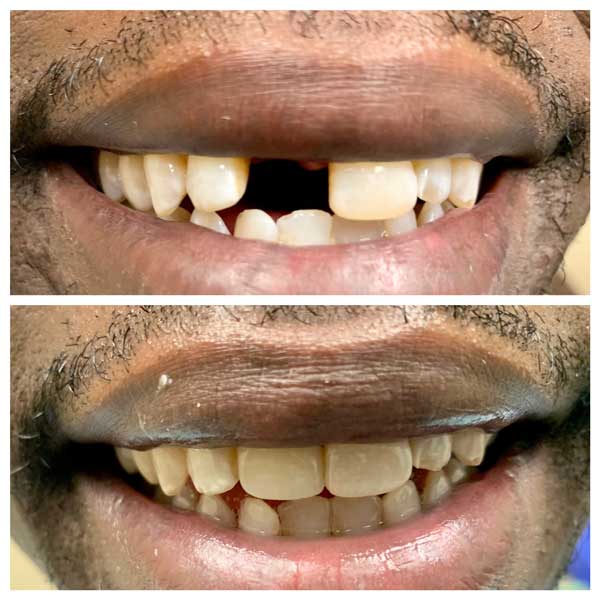 Single Dental Implant Before After