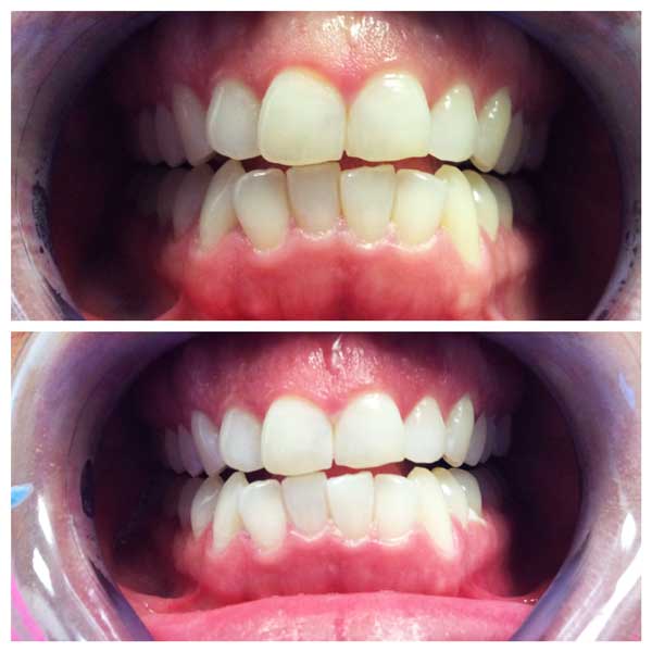 Zoom Teeth Whitening Before & After