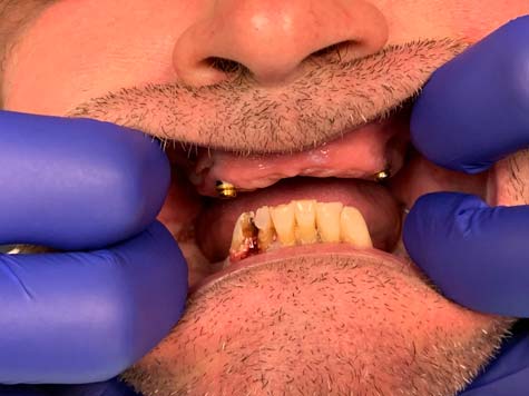 decayed bottom teeth before removal