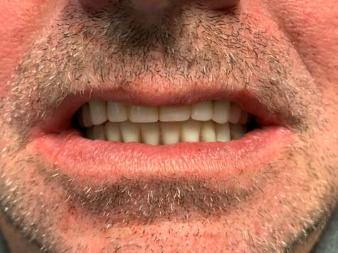 All-on-4 implants after smile