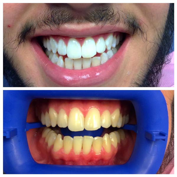 Professional Teeth Whitening from Irving Before After