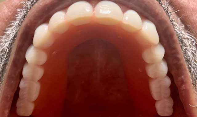 upper arch fixed denture placed