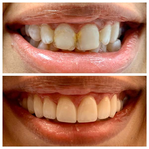 Elite Dental Crowns Before and Ater