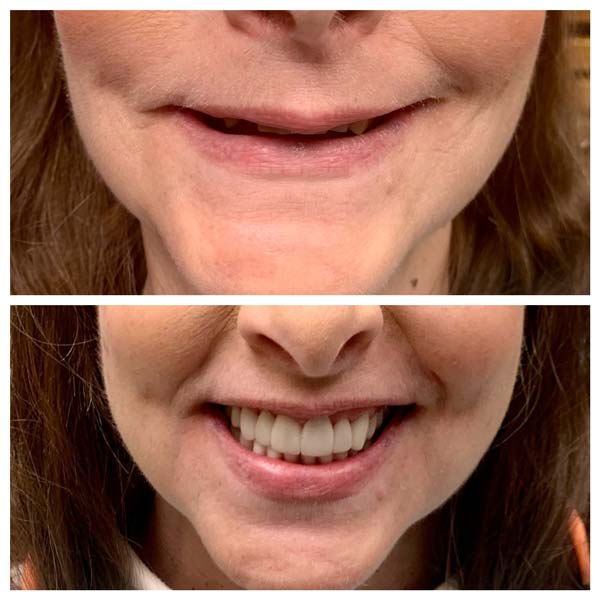 dental crowns and denture smile before and after