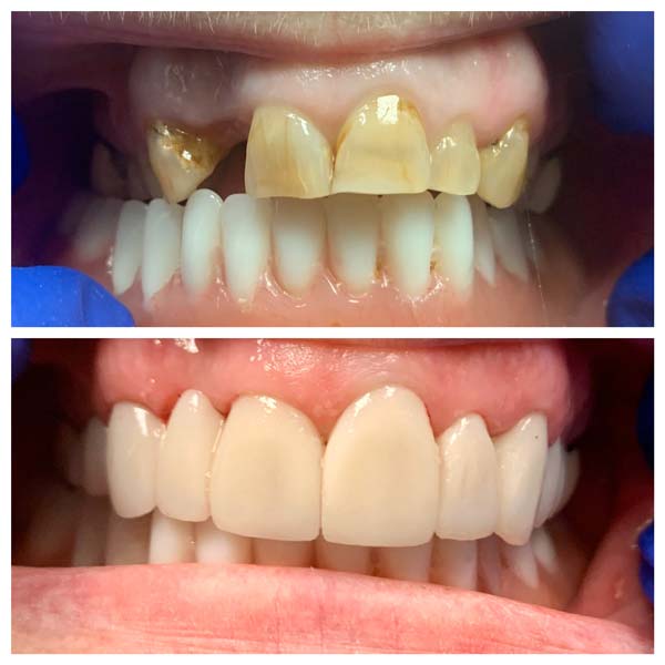dental crowns and denture before after