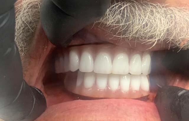 After Upper and Lower Implant Dentures