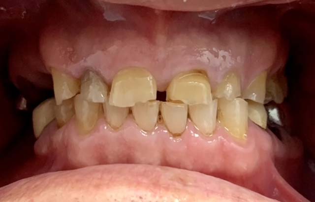 Rotting Teeth Prior to Implants