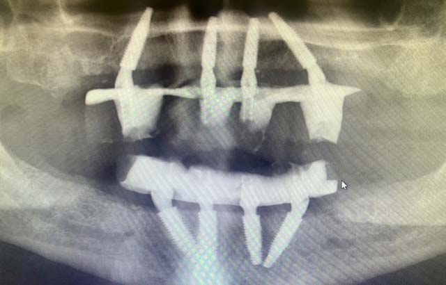 X Ray of Upper and Lower Implant Supported Dentures