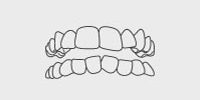 Overcrowding: Teeth are too close together causing shifting.