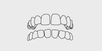 Gap Teeth: Extra space between one or more teeth.
