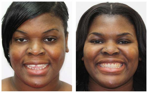 Invisalign Before & After Full Face Photo