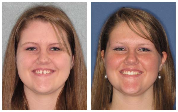 Invisalign Before & After Full Face Photo