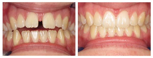 Invisalign Before & After Mouth Photo