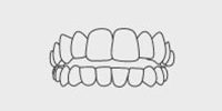 Open Bite: Top and bottom teeth don’t meet.