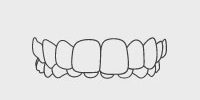 Overbite: Upper front teeth close in front of the lower teeth.