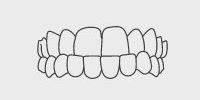 Underbite: Lower teeth protrude past upper front teeth.