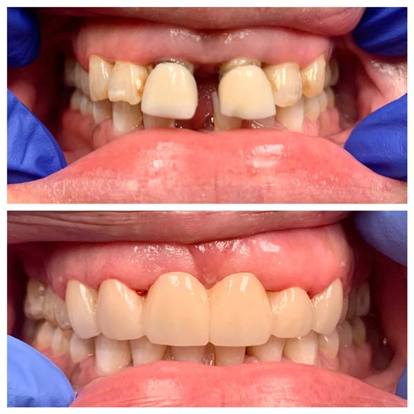 Dental Implant Bridge Before After