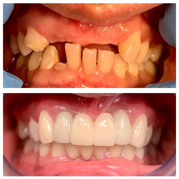 Full Mouth Implants Before After