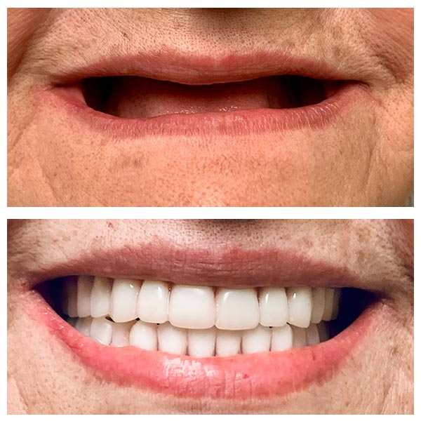 Complete Dentures Before After Photo