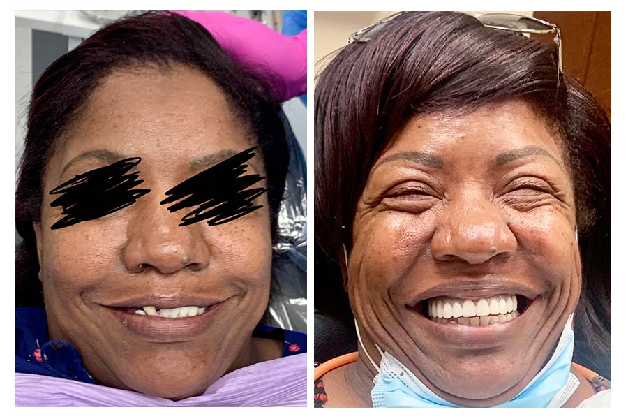 Before After Full Face Dental Implants