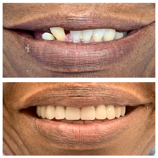 Before After Snap On Dentures