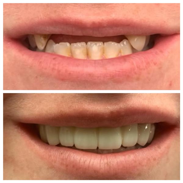 Top Dental Implants Before After