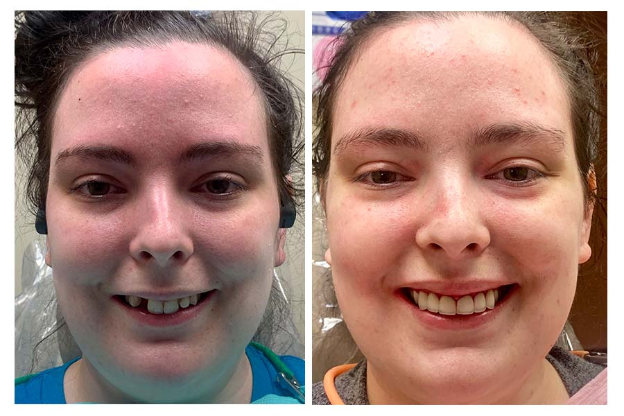 Full Face Before After Veneers Implants