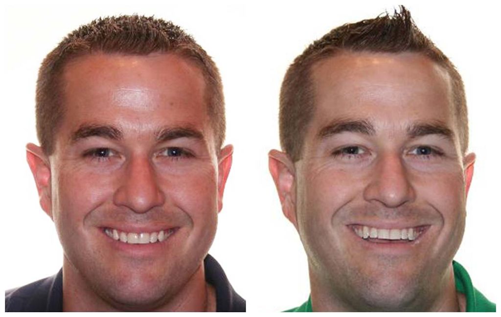Straight Teeth Before After Invisalign Adult Male