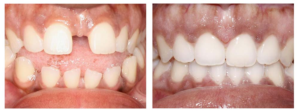 Before After Invisalign Gapped Teeth Woman Teeth