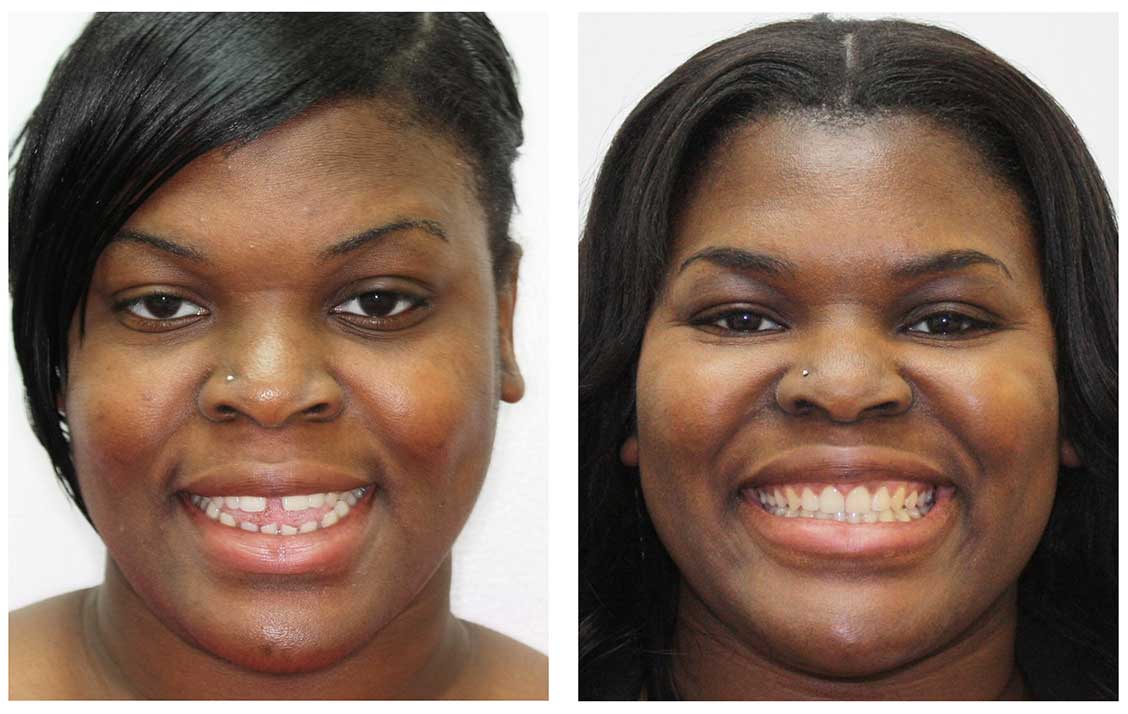 Before After Invisalign Gapped Teeth Woman
