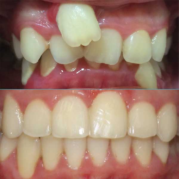 Crowding with Blocked Teeth Before After Fastbraces