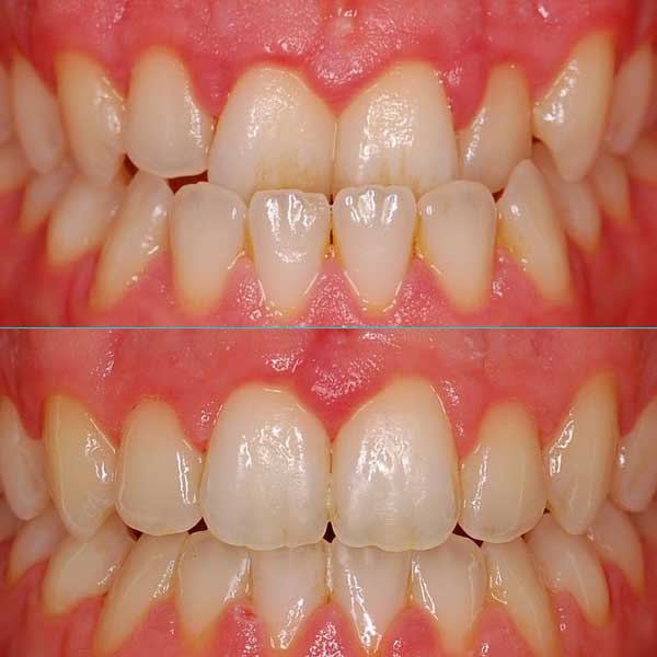 Crowding with Underbite Before After Fastbraces
