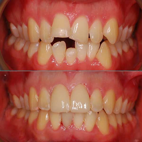 Crowding Teeth With Opening Before After Fastbraces