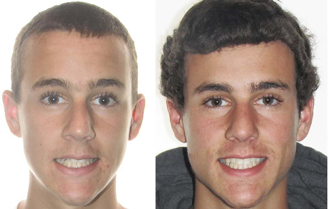 Before After Invisalign Teenage Boy