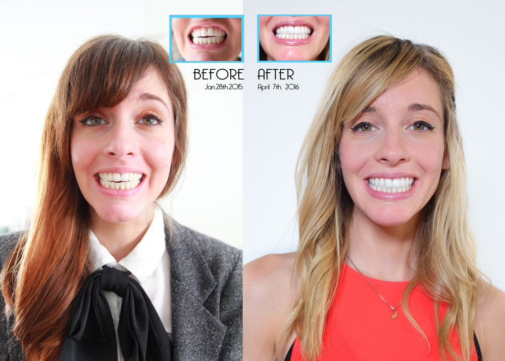 Female Before After Invisalign