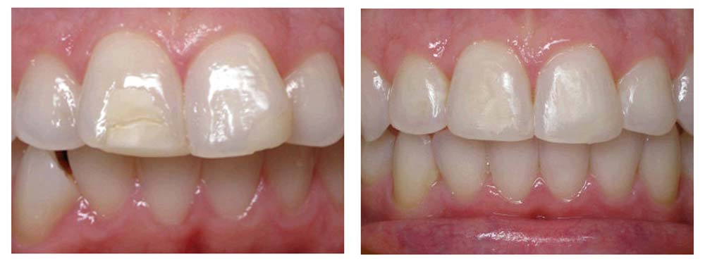 Straight Teeth Before After Invisalign Woman Teeth